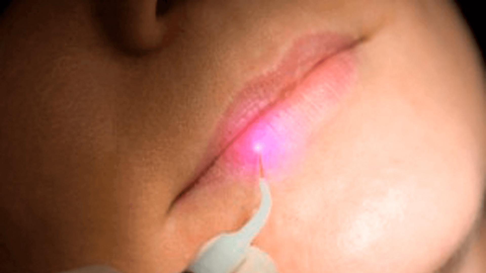 Dental laser for cold sores