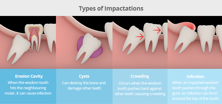 A chart of types of wisdom teeth impactions
